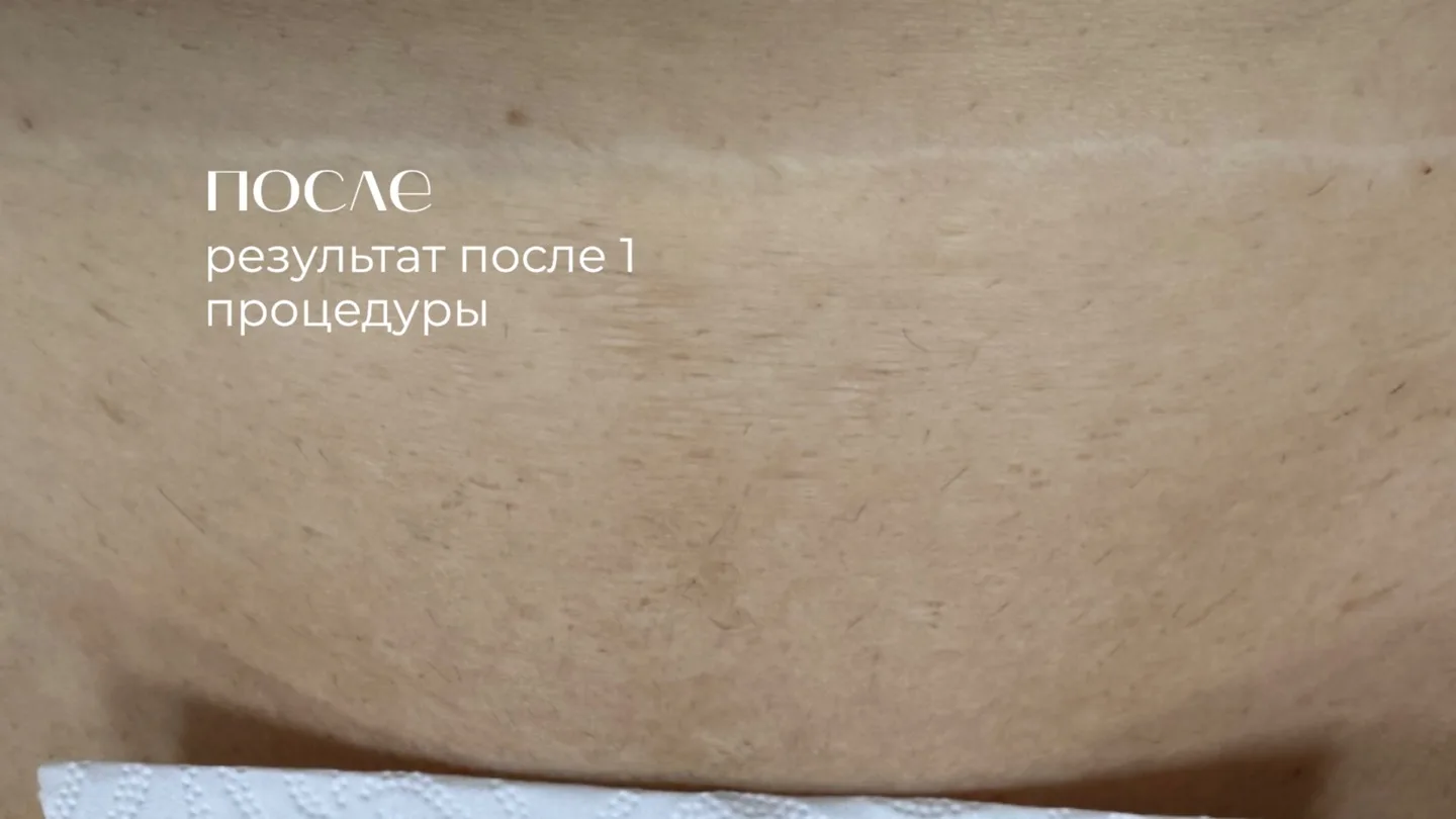 Зона бикини после первой процедуры лазерной эпиляции: волосы отрастают ровнее и реже
